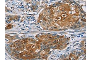 The image on the left is immunohistochemistry of paraffin-embedded Human cervical cancer tissue using ABIN7192209(RORB Antibody) at dilution 1/30, on the right is treated with synthetic peptide. (RORB antibody)