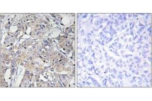 Immunohistochemistry analysis of paraffin-embedded human breast carcinoma tissue, using Collagen VI alpha3 Antibody. (COL6a3 antibody  (AA 2261-2310))