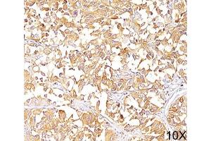 IHC staining of human melanoma (10X) with gp100 antibody (HMB45).