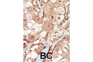 Formalin-fixed and paraffin-embedded human cancer tissue reacted with PDGFRB polyclonal antibody  , which was peroxidase-conjugated to the secondary antibody, followed by AEC staining. (PDGFRB antibody  (N-Term))
