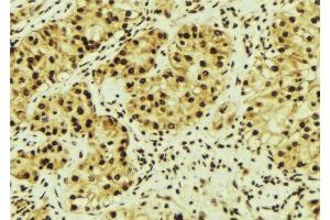 ABIN6276504 at 1/100 staining Human breast cancer tissue by IHC-P. (MAGED1 antibody  (Internal Region))