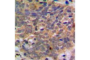 Immunohistochemical analysis of AKT (pS473) staining in human breast cancer formalin fixed paraffin embedded tissue section.