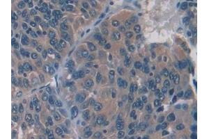 Detection of IL12A in Human Liver cancer Tissue using Monoclonal Antibody to Interleukin 12A (IL12A)