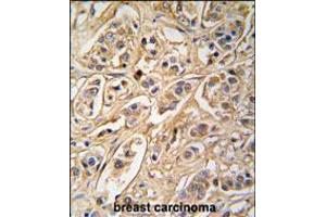 Formalin-fixed and paraffin-embedded human breast carcinoma tissue reacted with 14-3-3 protein zeta/delta antibody , which was peroxidase-conjugated to the secondary antibody, followed by DAB staining. (14-3-3 zeta antibody  (AA 216-245))