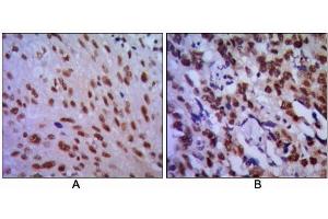 Immunohistochemical analysis of paraffin-embedded human lung cancer (A) and esophageal cancer (B), showing cytoplasmic localization using CDC2 antibody with DAB staining. (CDK1 antibody)