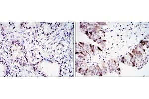 Immunohistochemical analysis of paraffin-embedded lung cancer (left) and ovary tumour tissues (right) using CCNB1 mouse mAb with DAB staining.