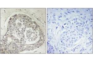 Immunohistochemistry analysis of paraffin-embedded human breast carcinoma, using K0100 Antibody. (KIAA0100/BCOX1 antibody  (AA 681-730))