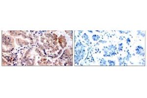 Immunohistochemical analysis of paraffin-embedded human lung carcinoma tissue, using AMPK1 (Ab-174) antibody (E021191). (PRKAA1 antibody)