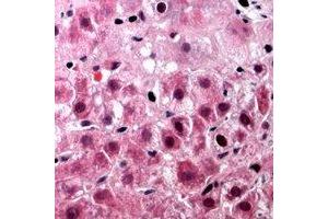 Immunohistochemical analysis of TUFM staining in human liver cancer formalin fixed paraffin embedded tissue section.