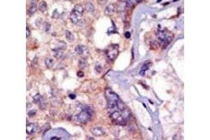 IHC analysis of FFPE human breast carcinoma tissue stained with the LCK antibody (LCK antibody  (AA 23-52))