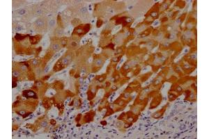 IHC image of ABIN7127603 diluted at 1:100 and staining in paraffin-embedded human liver cancer performed on a Leica BondTM system. (Recombinant LRG1 antibody)