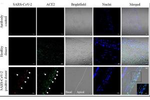 Immunostaining of corneal tissue from postmortem donors with and without COVID-19-positive PCR for spike protein from SARS-CoV-2 (red) and ACE2 (green) indicated with white arrows, with nuclei in blue.