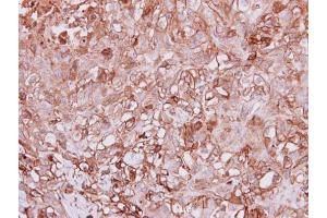 IHC-P Image Immunohistochemical analysis of paraffin-embedded DU145 xenograft, using Angiopoietin 4, antibody at 1:100 dilution. (Angiopoietin 4 antibody  (N-Term))