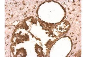 IHC-P Image XLF antibody [N3C3] detects XLF protein on human ovarian carcinoma by immunohistochemical analysis.