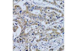 Immunohistochemistry of paraffin-embedded human colon carcinoma using TPPP3 antibody (ABIN2560511) at dilution of 1:100 (40x lens).