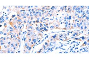 Immunohistochemistry of paraffin-embedded Human lung cancer tissue using SMG8 Polyclonal Antibody at dilution 1:50 (SMG8 antibody)