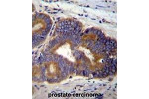 Formalin fixed, paraffin embedded human prostate carcinoma stained with YI016 Antibody (C-term) followed by peroxidase conjugation of the secondary antibody and DAB staining. (YI016 (AA 260-288), (C-Term) antibody)