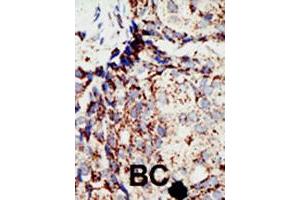 Formalin-fixed and paraffin-embedded human cancer tissue reacted with BAP1 polyclonal antibody  , which was peroxidase-conjugated to the secondary antibody, followed by DAB staining. (BAP1 antibody  (N-Term))