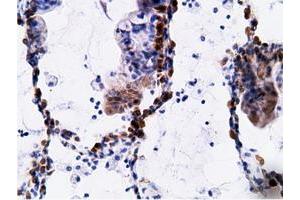 Immunohistochemical staining of paraffin-embedded Adenocarcinoma of Human breast tissue using anti-EPHX2 mouse monoclonal antibody.