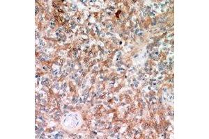Immunohistochemical analysis of TRP2 staining in human breast cancer formalin fixed paraffin embedded tissue section. (DCT antibody)