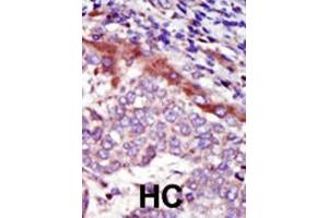Formalin-fixed and paraffin-embedded human cancer tissue reacted with the primary antibody, which was peroxidase-conjugated to the secondary antibody, followed by AEC staining. (HUNK antibody  (C-Term))