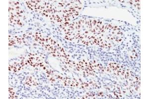 Formalin-fixed, paraffin-embedded human bladder carcinoma stained with p57 antibody (57P06). (CDKN1C antibody)