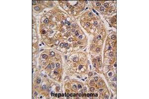 Formalin-fixed and paraffin-embedded human hepatocarcinoma tissue reacted with AKR1A1 antibody , which was peroxidase-conjugated to the secondary antibody, followed by DAB staining. (AKR1A1 antibody  (C-Term))
