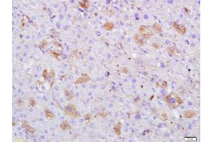 Paraformaldehyde-fixed, paraffin embedded human hepatocellular carcinoma, Antigen retrieval by boiling in sodium citrate buffer (pH6) for 15min, Block endogenous peroxidase by 3% hydrogen peroxide for 30 minutes, Blocking buffer (normal goat serum) at 37°C for 20min, Antibody incubation with Serum albumin (3F4) Monoclonal Antibody, Unconjugated (bsm-0945M) at 1:500 overnight at 4°C, followed by a conjugated secondary and DAB staining. (Albumin antibody)