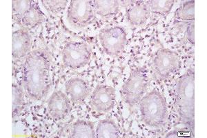 Formalin-fixed and paraffin embedded human gastric carcinoma labeled with Rabbit Anti BCL-6/5 Polyclonal Antibody, Unconjugated  at 1:200 followed by conjugation to the secondary antibody and DAB staining (BCL6 antibody  (AA 501-600))