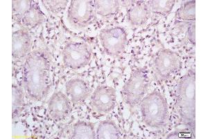 Formalin-fixed and paraffin embedded human gastric carcinoma labeled with Rabbit Anti BCL-6/5 Polyclonal Antibody, Unconjugated  at 1:200 followed by conjugation to the secondary antibody and DAB staining (BCL6 antibody  (AA 501-600))