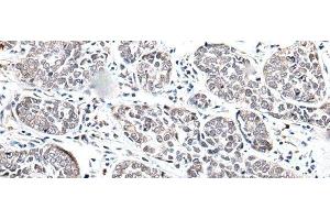 Immunohistochemistry of paraffin-embedded Human esophagus cancer tissue using BRMS1L Polyclonal Antibody at dilution of 1:45(x200) (BRMS1L antibody)