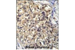KLHL35 Antibody (C-term) (ABIN656072 and ABIN2845420) immunohistochemistry analysis in formalin fixed and paraffin embedded human breast carcinoma followed by peroxidase conjugation of the secondary antibody and DAB staining. (KLHL35 antibody  (C-Term))