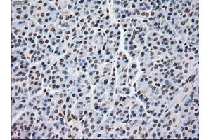 Immunohistochemical staining of paraffin-embedded Adenocarcinoma of breast tissue using anti-MRI1 mouse monoclonal antibody. (MRI1 antibody)
