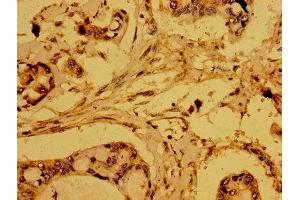 Immunohistochemistry of paraffin-embedded human pancreatic cancer using ABIN7168921 at dilution of 1:100 (HTRA2 antibody  (AA 334-458))