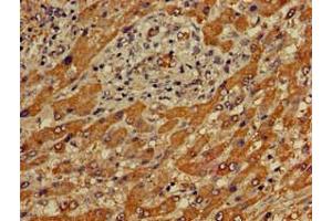 Immunohistochemistry of paraffin-embedded human liver cancer using ABIN7166683 at dilution of 1:100