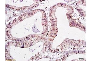 Formalin-fixed and paraffin embedded human gastric carcinoma labeled with Anti-WWOX Polyclonal Antibody , Unconjugated at 1:200, followed by conjugation to the secondary antibody and DAB staining (WWOX antibody  (AA 5-100))