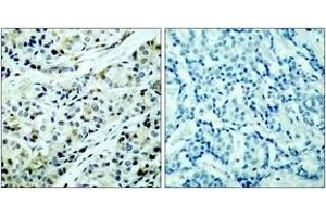 Immunohistochemistry analysis of paraffin-embedded human breast carcinoma, using HDAC5 (Phospho-Ser498) Antibody. (HDAC5 antibody  (pSer498))