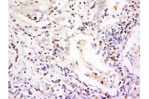 Paraformaldehyde-fixed, paraffin embedded human lung cancer, Antigen retrieval by boiling in sodium citrate buffer (pH6) for 15min, Block endogenous peroxidase by 3% hydrogen peroxide for 30 minutes, Blocking buffer (normal goat serum) at 37°C for 20min, Antibody incubation with Rabbit Anti-CD94/KLRD1 Polyclonal Antibody, Unconjugated  at 1:500 overnight at 4°C, followed by a conjugated secondary and DAB staining. (CD94 antibody  (AA 71-179))