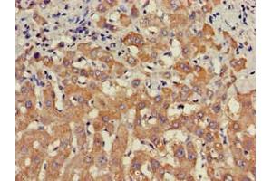 Immunohistochemistry of paraffin-embedded human liver cancer using ABIN7169681 at dilution of 1:100 (STAT4 antibody  (AA 569-748))