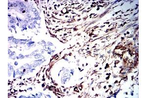 Immunohistochemical analysis of paraffin-embedded rectum cancer tissues using VIM mouse mAb with DAB staining. (Vimentin antibody  (AA 2-466))