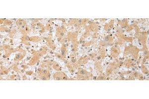 Immunohistochemistry of paraffin-embedded Human liver cancer tissue using DHRSX Polyclonal Antibody at dilution of 1:30(x200)