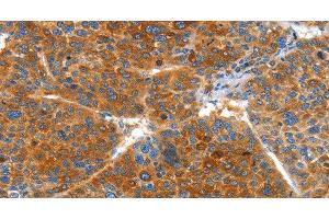 Immunohistochemistry of paraffin-embedded Human liver cancer using VWA5A Polyclonal Antibody at dilution of 1:60
