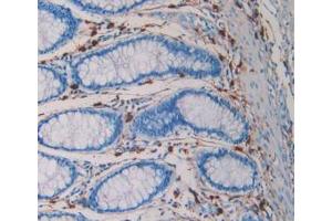 DAB staining on IHC-P; Samples: Human Rectum Cancer Tissue (TPSAB1 antibody  (AA 161-262))