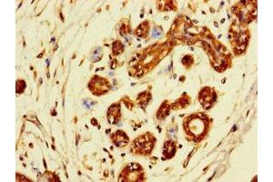 Immunohistochemistry of paraffin-embedded human breast cancer using ABIN7171277 at dilution of 1:100 (SDCBP2 antibody  (AA 11-207))