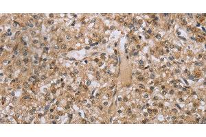 Immunohistochemistry of paraffin-embedded Human prostate cancer tissue using RAB39B Polyclonal Antibody at dilution 1:45 (RAB39B antibody)