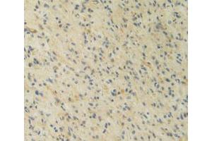 IHC-P analysis of Human Glioma Tissue, with DAB staining. (IL12A antibody  (AA 23-219))