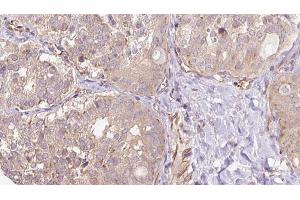 ABIN6273317 at 1/100 staining Human thyroid cancer tissue by IHC-P.