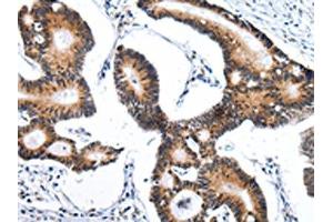 The image on the left is immunohistochemistry of paraffin-embedded Human tonsil tissue using ABIN7193115(ZNF473 Antibody) at dilution 1/30, on the right is treated with synthetic peptide. (ZNF473 antibody)