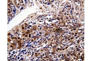 IHC-P: DDT antibody testing of human lung cancer tissue (DDT antibody  (C-Term))