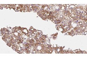ABIN6272348 at 1/100 staining Human liver cancer tissue by IHC-P.
